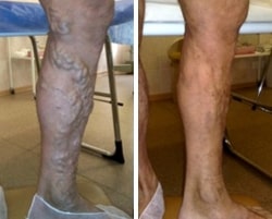 Крупный варикоз голени, фото после склеротерапии