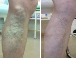 Результат после склеротерапии варикоза голени