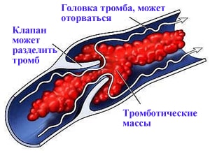 Тромбоз глубоких вен опасен ТЭЛА