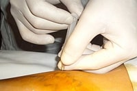 Минифлебэктомия - самый косметичный метод лечения варикозного расширения нижних конечностей